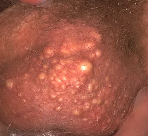 Sebaceous Cyst (Epidermal Cyst) - Pictures, Causes ...