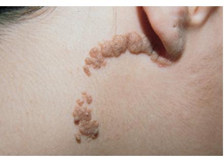 Epidermal Nevus Syndrome: Background, Pathophysiology ...