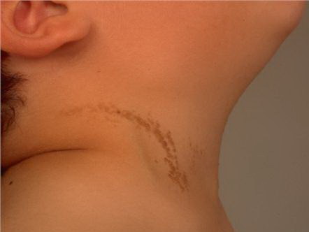 Congenital Hairy Nevi: Overview, Clinical Presentation ...