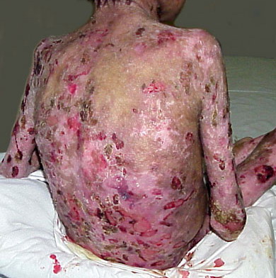 recessive dystrophic epidermolysis bullosa