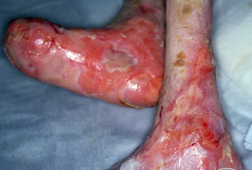 epidermolysis bullosa