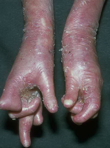 Epidermolysis bullosa simplex - Wikipedia