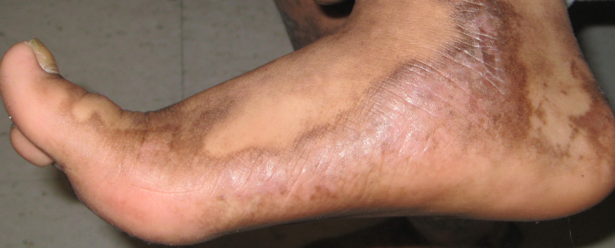 Lichen Planus Causes, Treatment, and Symptoms