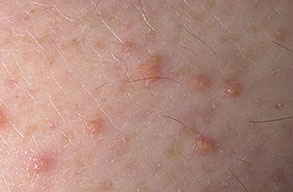 Xanthoma : MedlinePlus Medical Encyclopedia