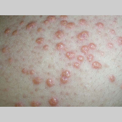 eruptive xanthoma