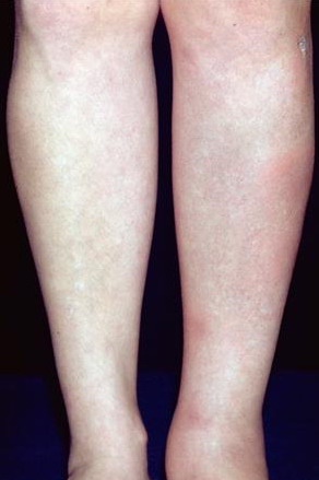 erythematous skin nodules