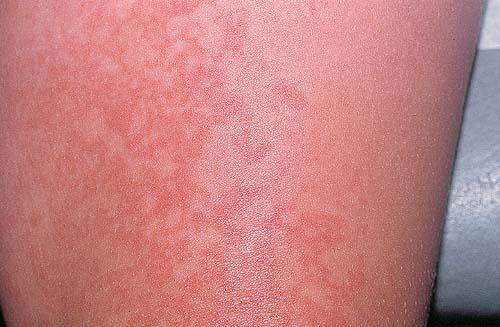 fifth disease rash pictures