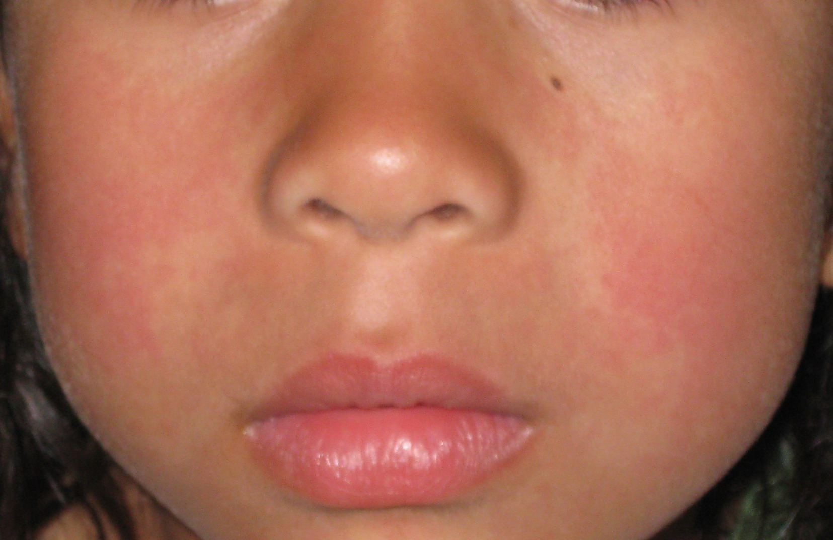 fifths disease rash pictures #11