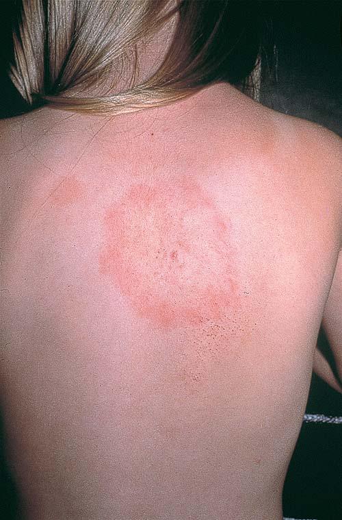 Erythema Chronicum Migrans information. Patient | Patient