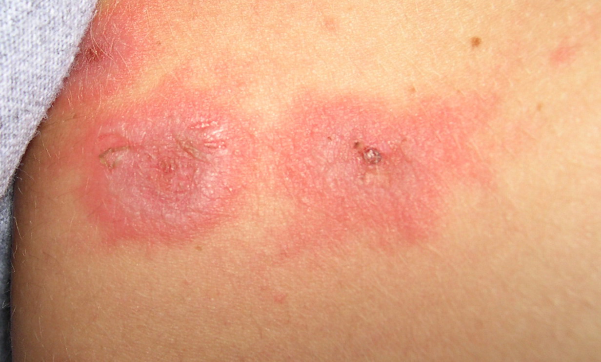 Toxic epidermal necrolysis and Stevens-Johnson syndrome