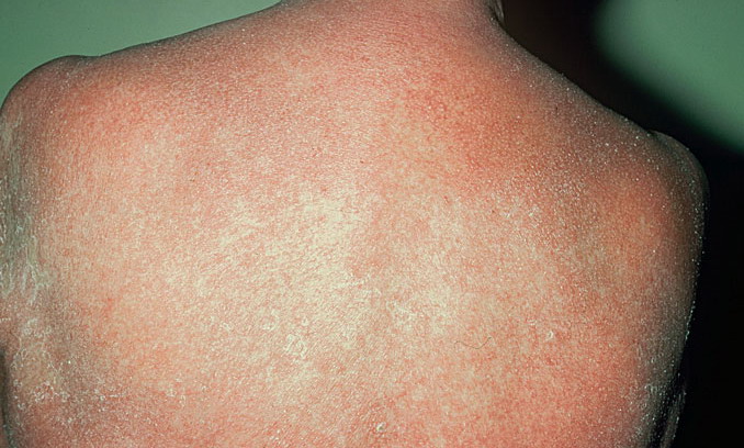 exfoliative erythroderma #10