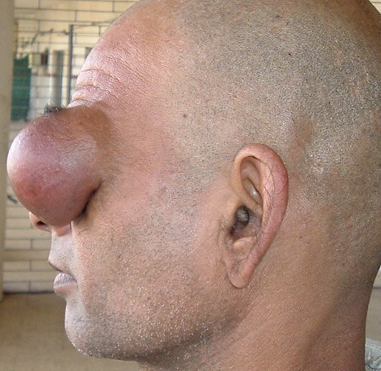 Nasal Dermoid Cyst