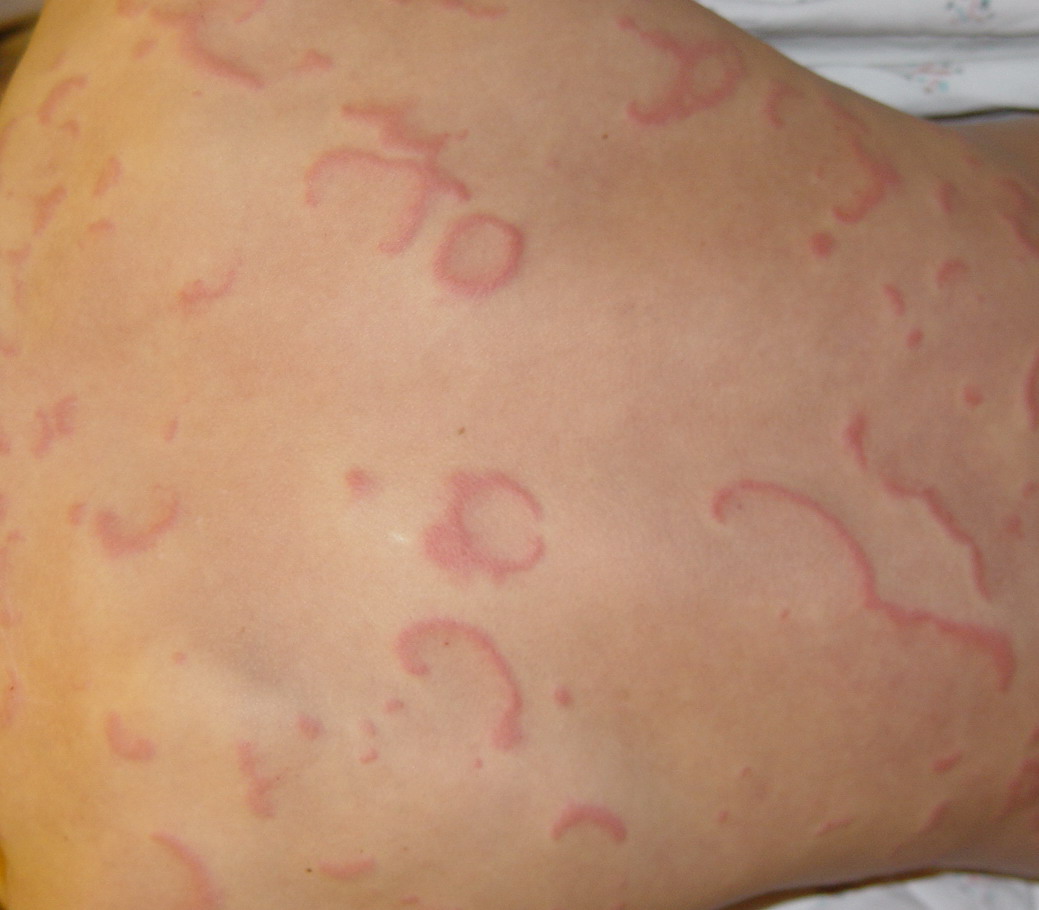 annular erythema