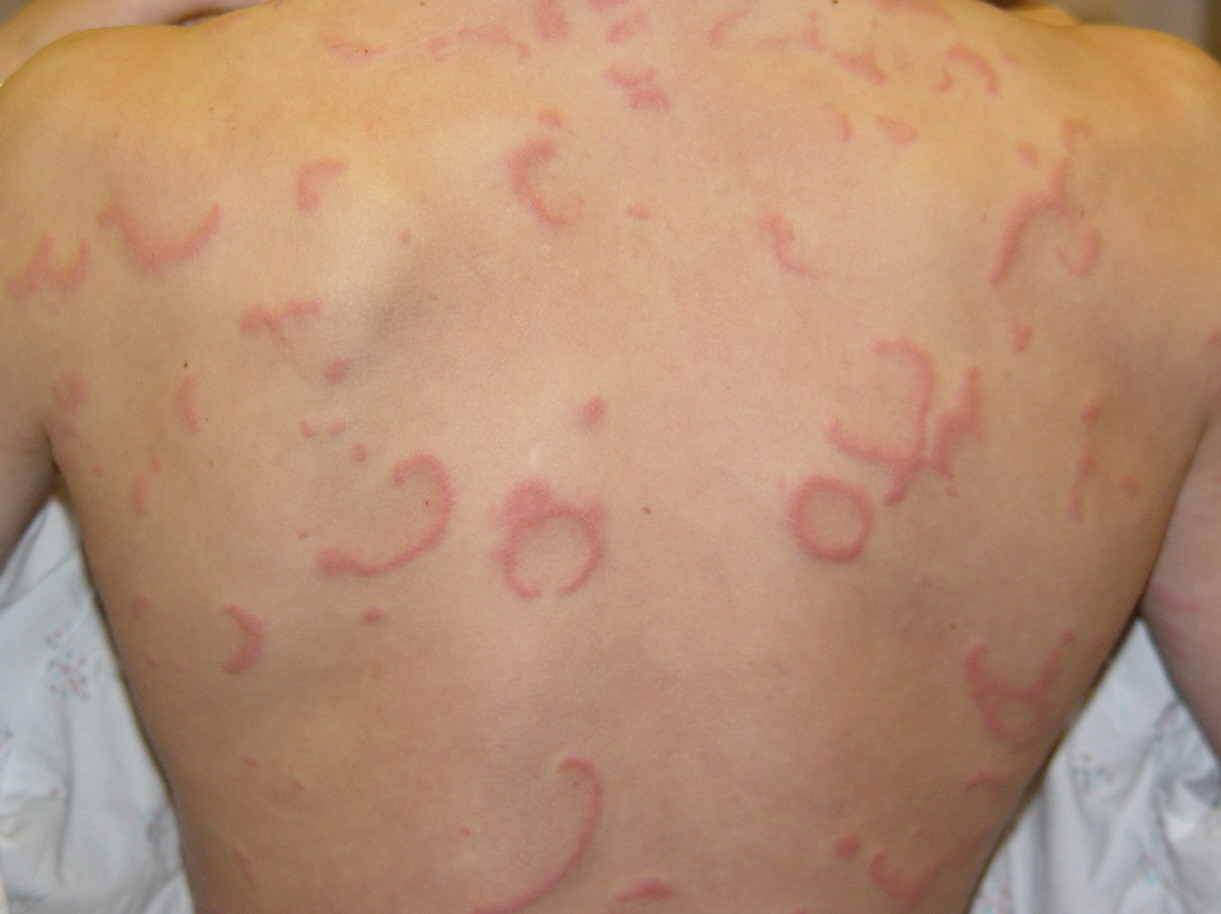 Erythema Annulare Centrifugum Treatment & Management ...