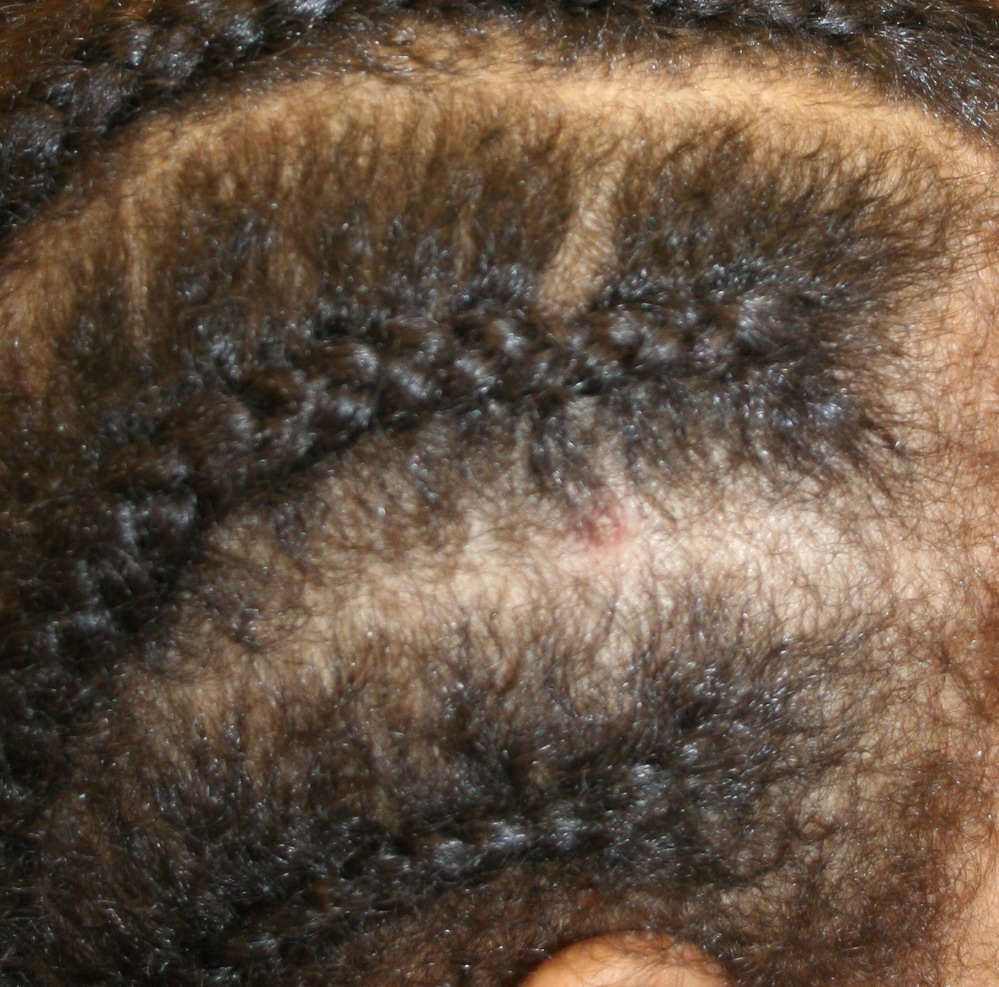 Superficial pustular folliculitis - Wikipedia