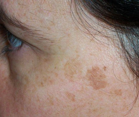 cancerous freckles