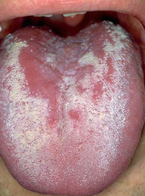 Throat Virus Greenish Mucous 103