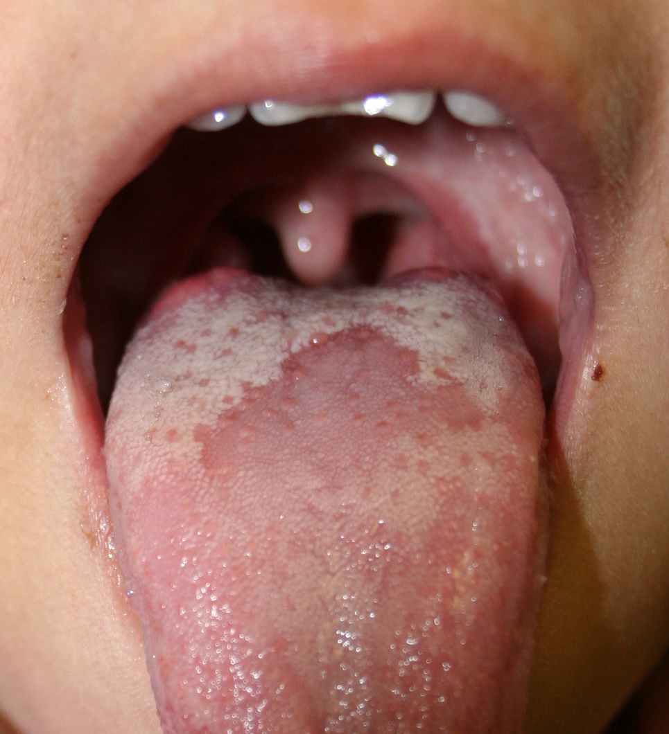 tongue cancer tongue cancer