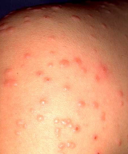 Dermatologic Manifestations of Gianotti-Crosti Syndrome ...