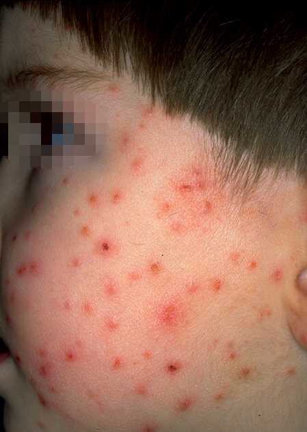 papular acrodermatitis