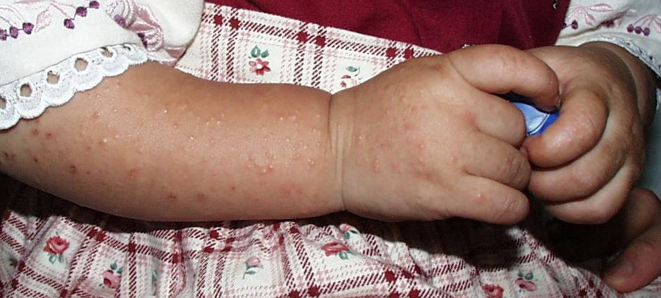 Papular acrodermatitis of childhood - RightDiagnosis.com