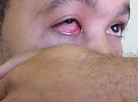 Gonococcal Pharyngitis