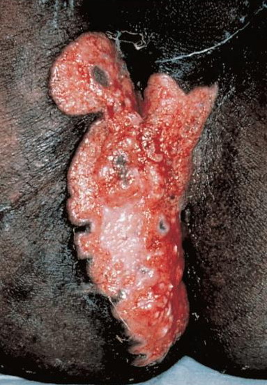klebsiella granulomatis
