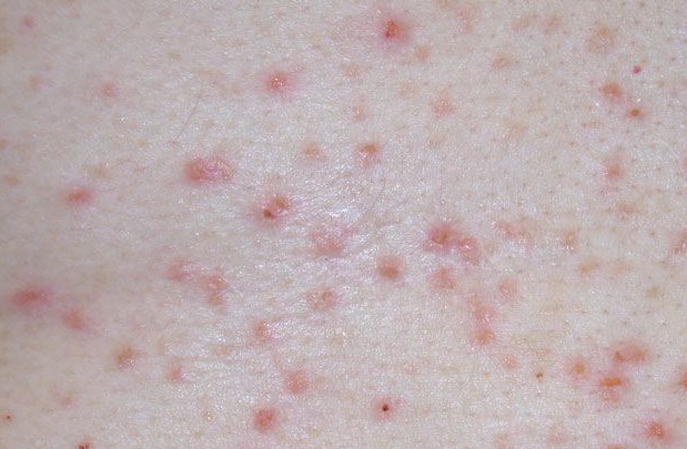 grovers syndrome