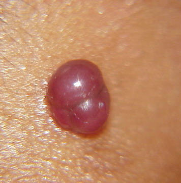 Picture of Strawberry Hemangiomas - WebMD