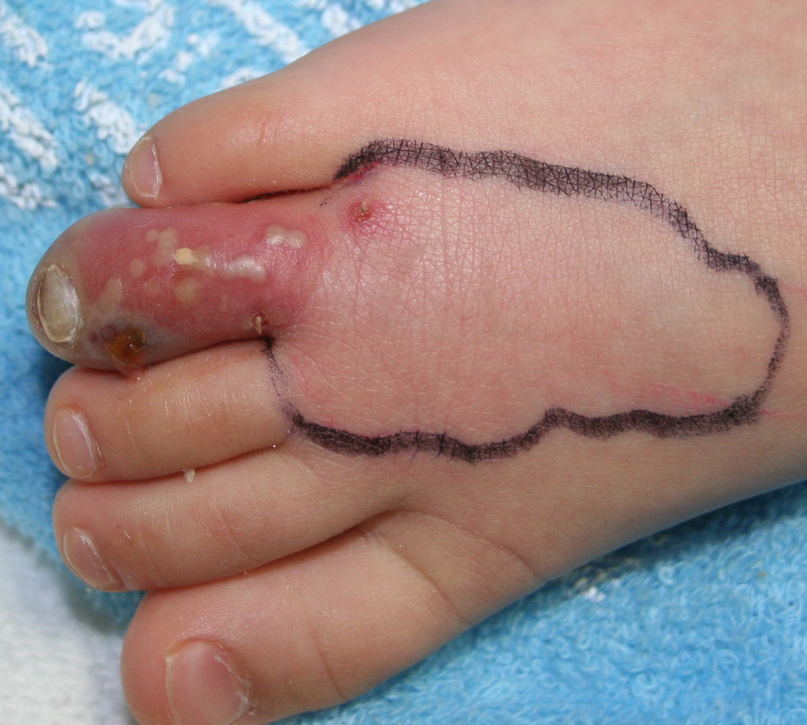 Herpetic Whitlow — NEJM