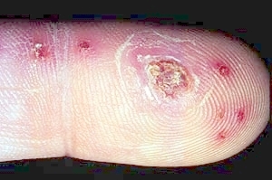 Herpetic Whitlow — NEJM