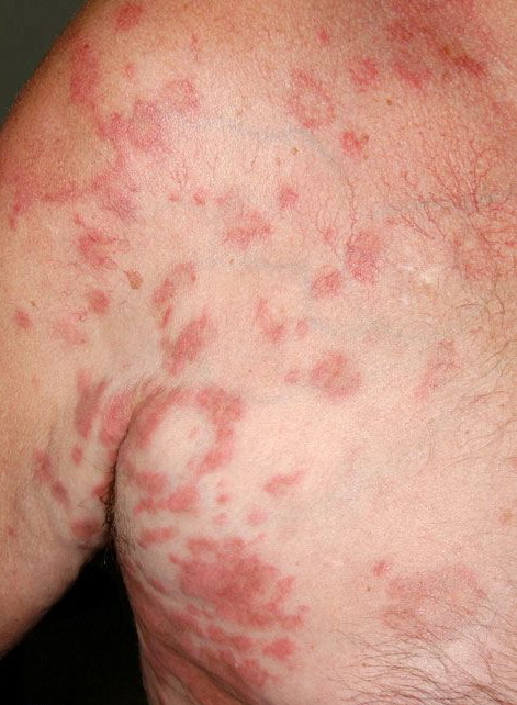 Spongiotic Dermatitis -Causes-Treatment - MedHelp