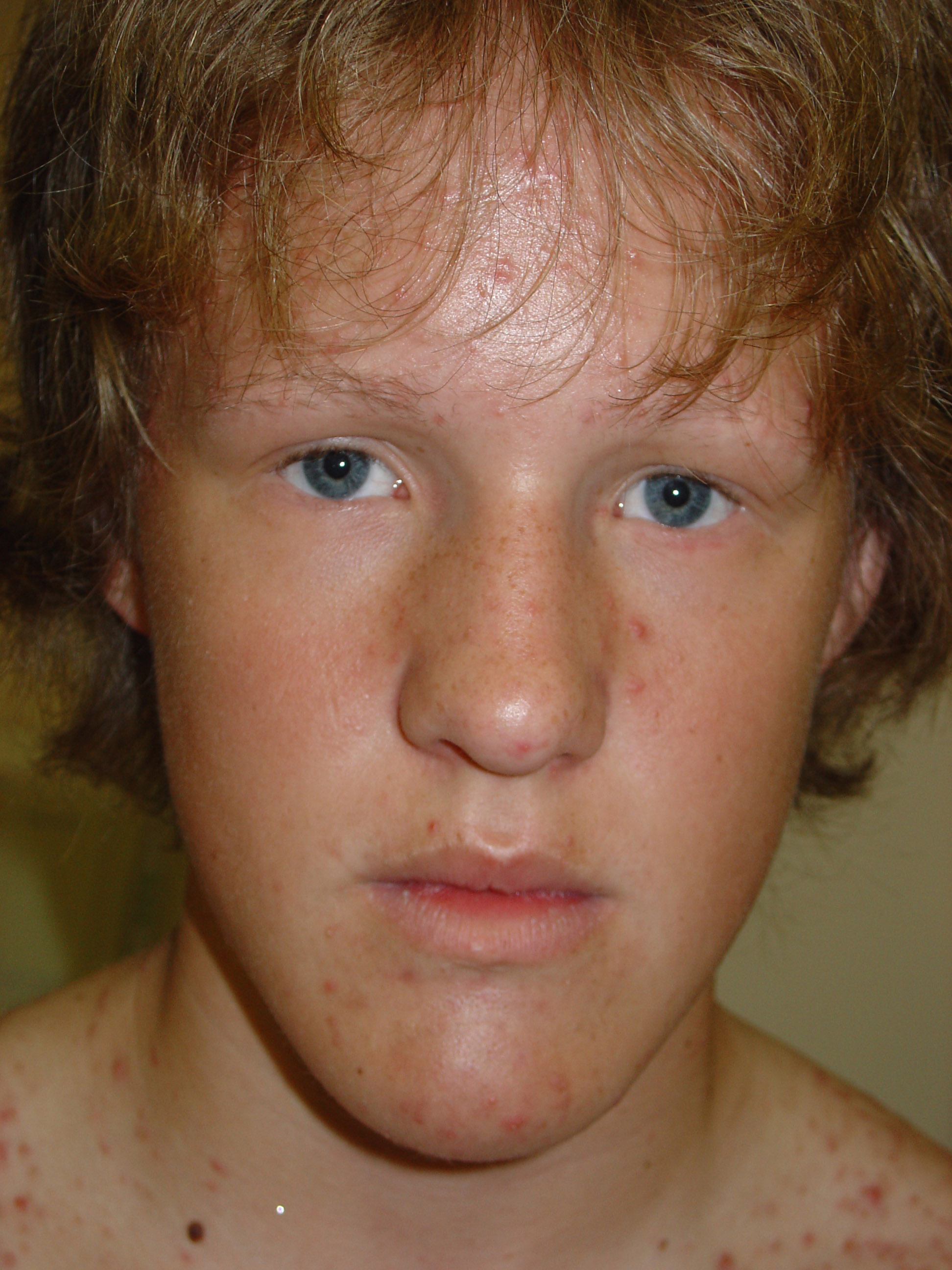 Ectodermal Dysplasia: Background, Pathophysiology ...