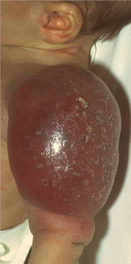 Kasabach―Merritt症候群を里した肝血管肉腫の1症例