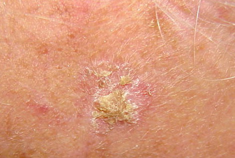 Disseminated superficial actinic porokeratosis | DermNet ...