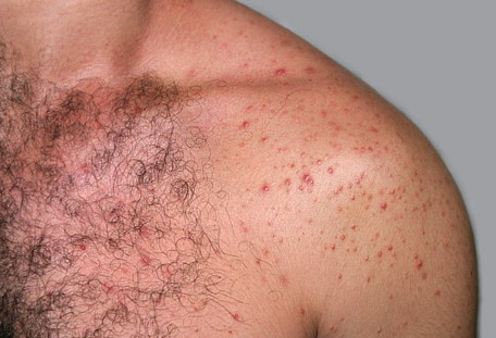 folliculitis symptoms