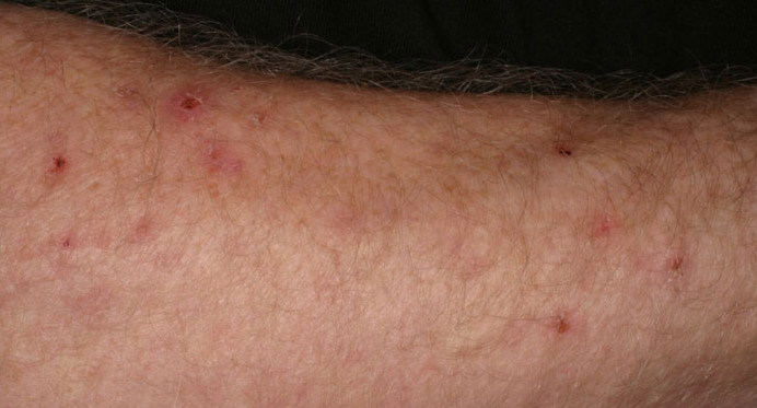 Irritant Contact Dermatitis in Adults: Condition ...