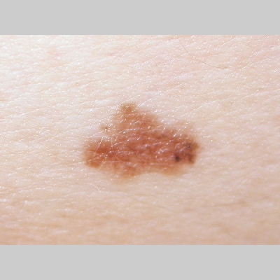 In situ melanoma | Cancer Research UK