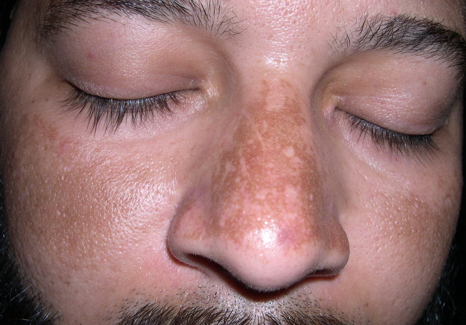 Melasma : Get the Facts on Treatment - MedicineNet