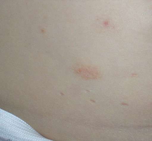 Molluscum contagiosum - Mayo Clinic