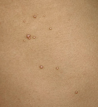 mollusum contagiosum
