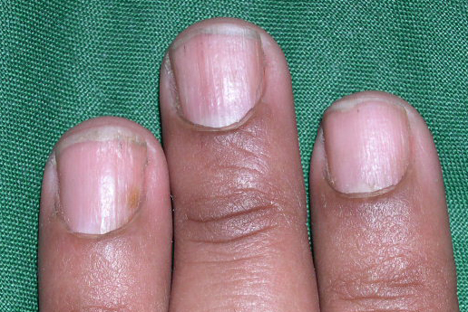 Twenty-nail dystrophy | Genetic and Rare Diseases ...
