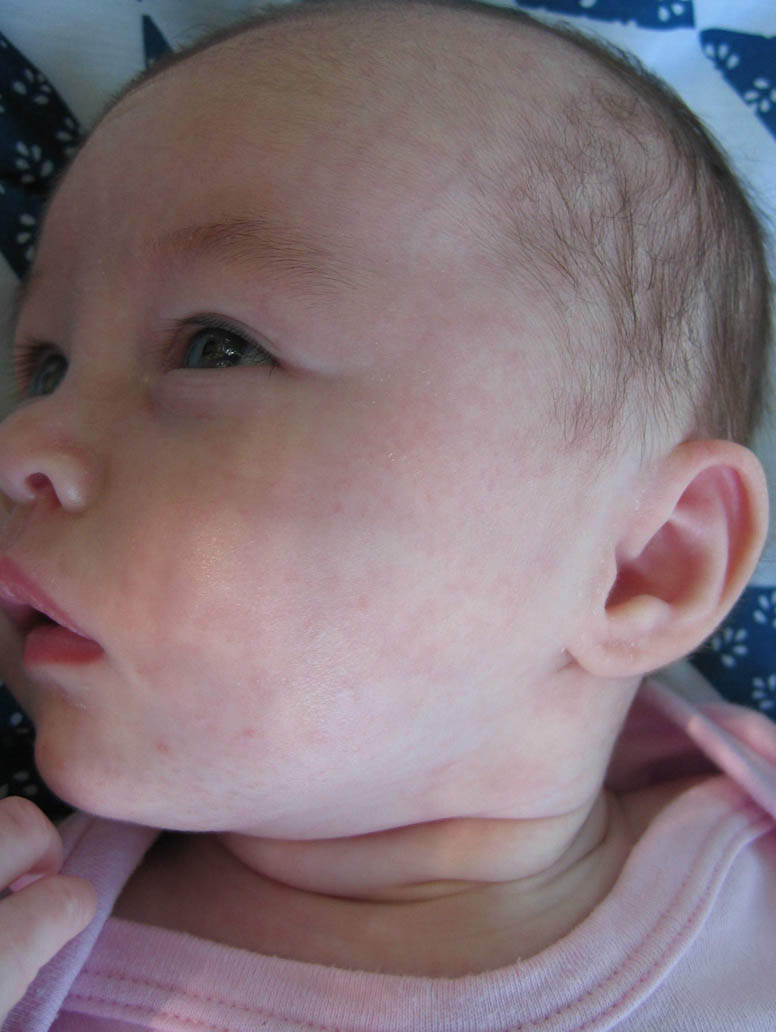 neonatal acne عد الوليد