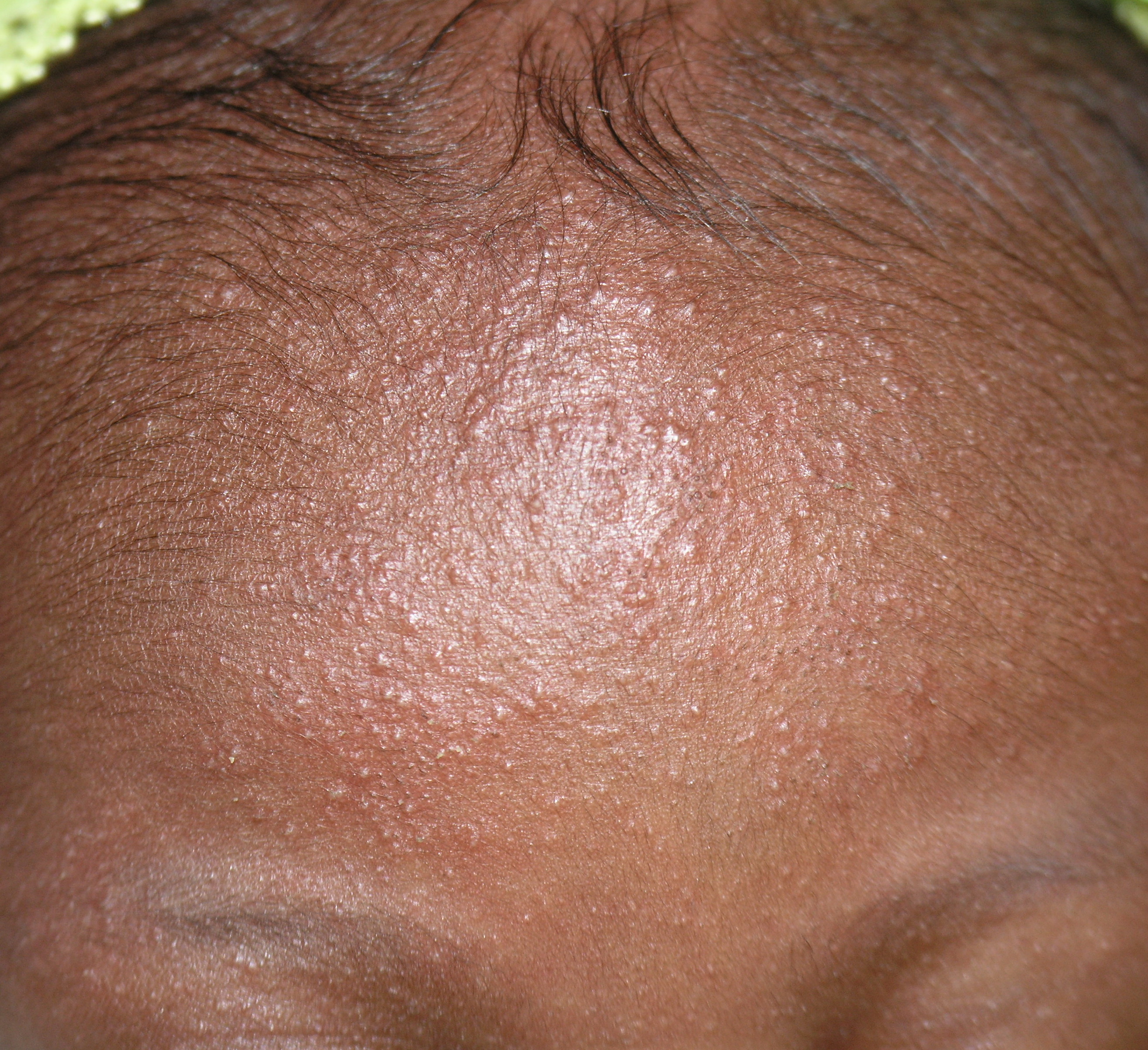 Neonatal Acne