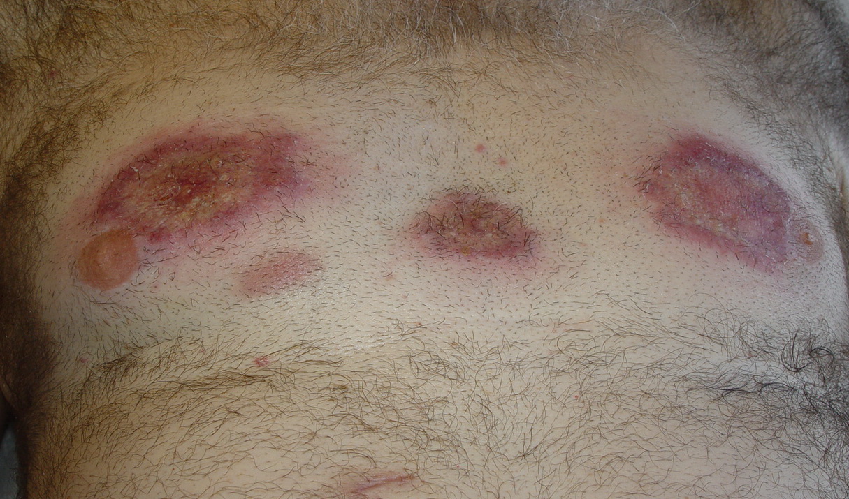 neutrophilic dermatosis