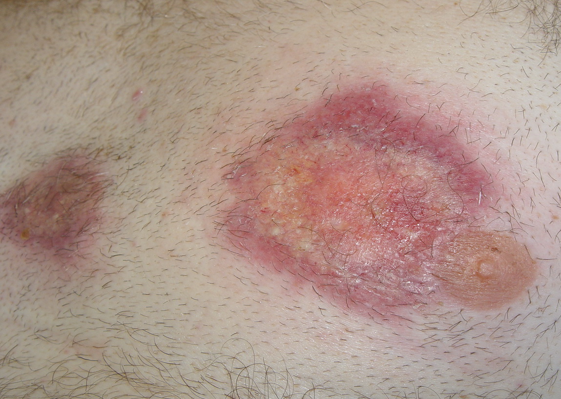 Acute Febrile Neutrophilic Dermatosis: Background ...