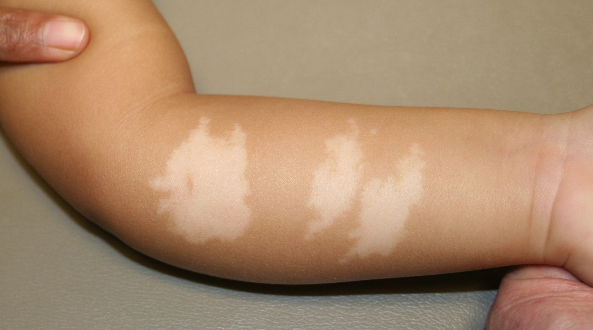 Hypopigmentation Treatments: 5 Methods That Really Work ...