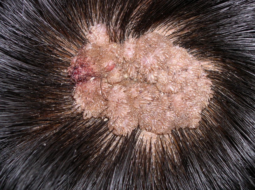 scalp nevus