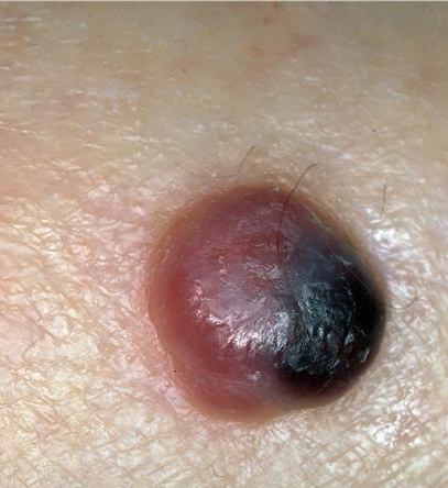 What Does Melanoma Look Like? - National Cancer Institute