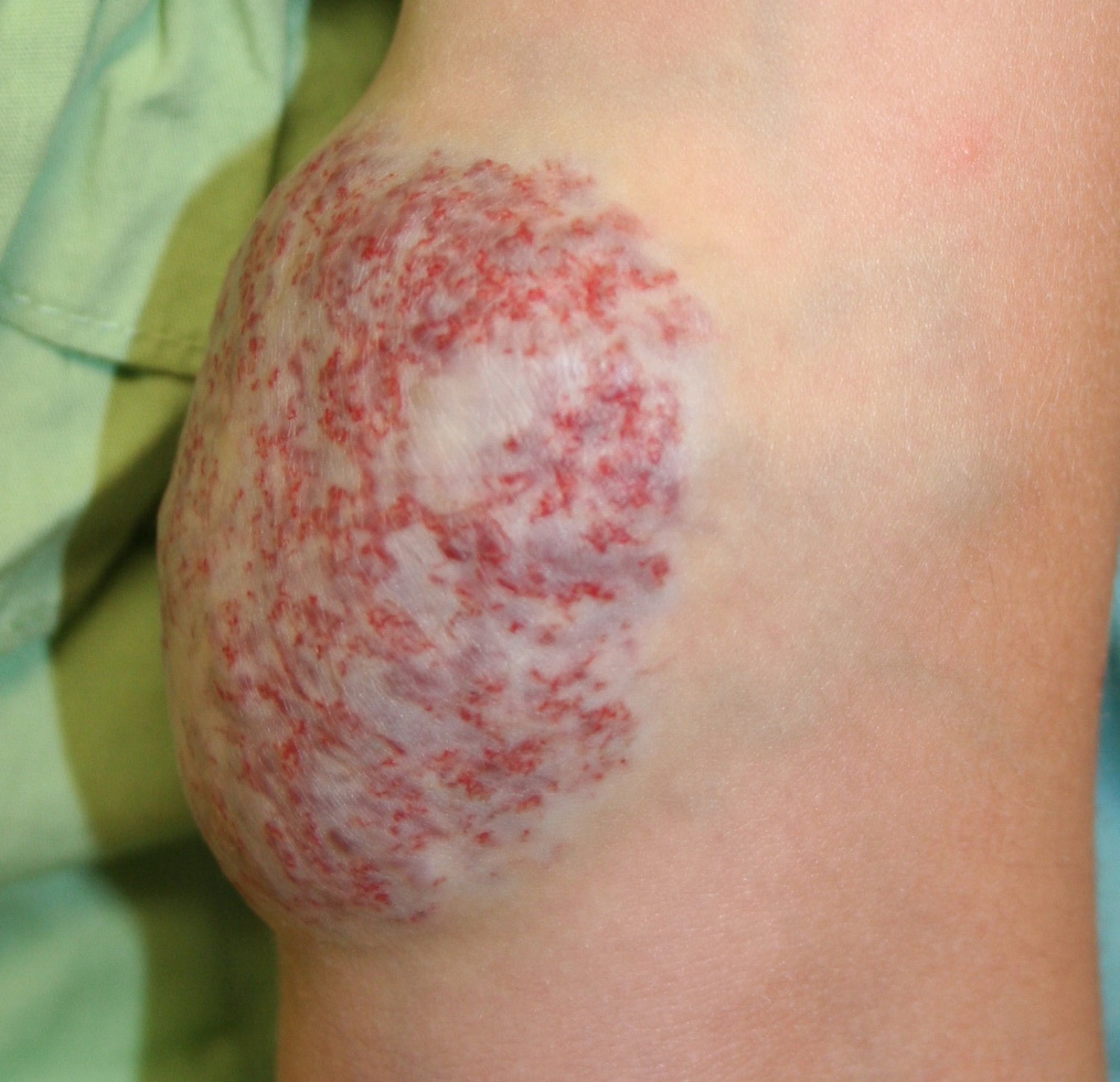 hemangioma pictures #10